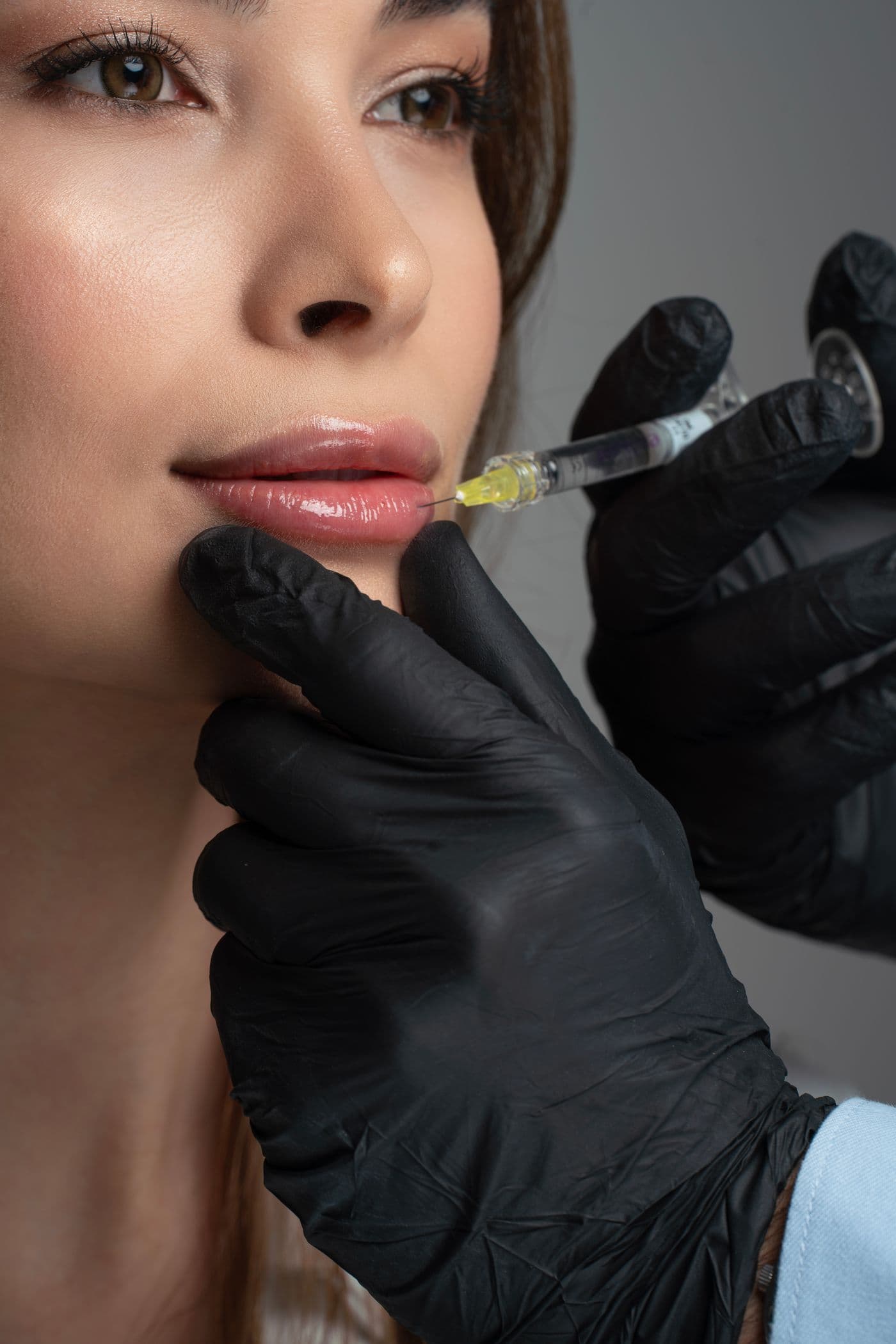 Close-up of a hyaluronic acid filler being placed in the lip by a gloved injector