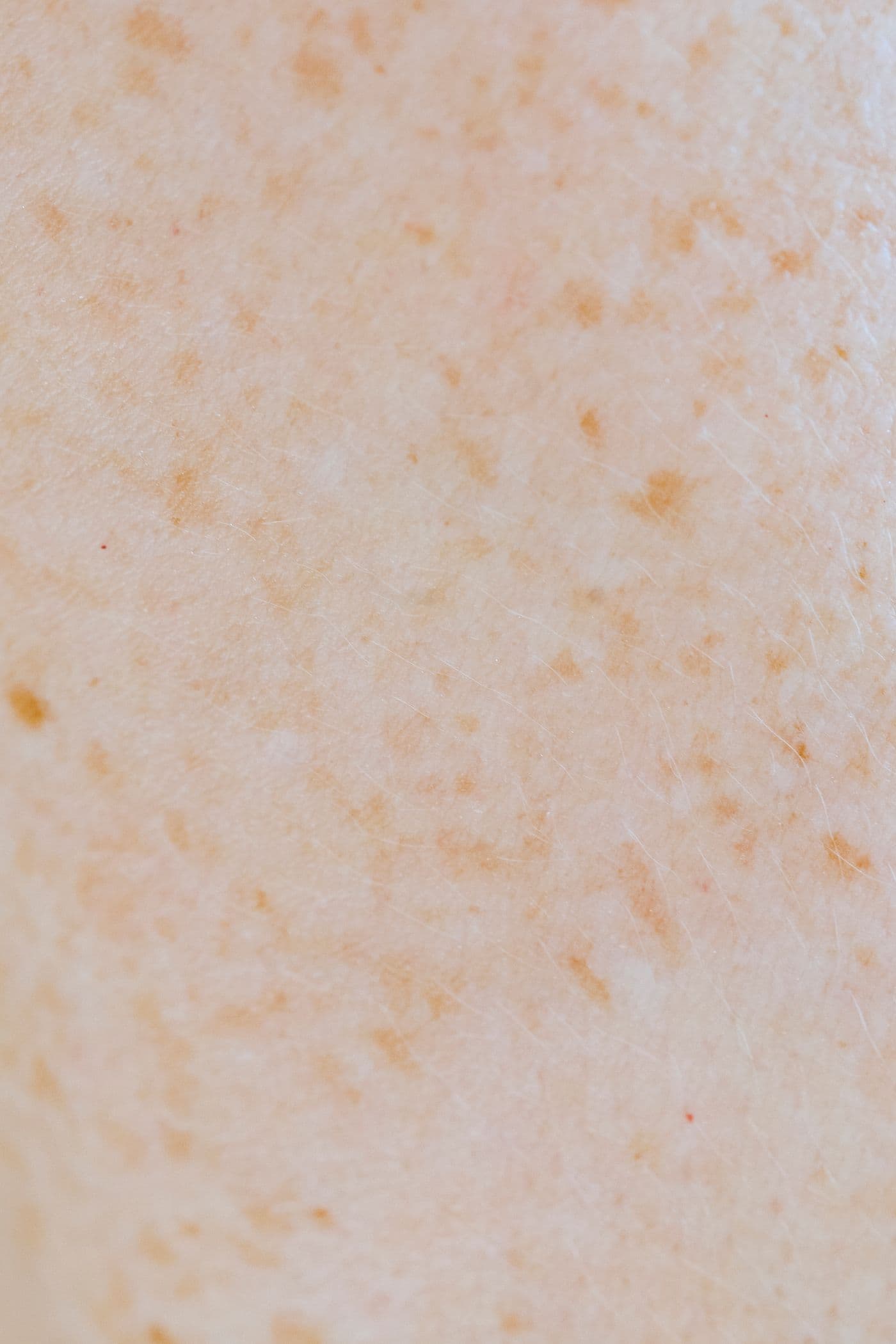 Macro view of cheek skin with scattered freckles and sun spots — visualized after treatment